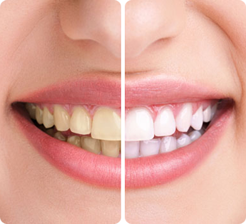 Before & After - Teeth Whitening Wheaton IL